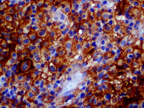PD-L1 Antibody Immunohistochemistry on a FFPE Hodgkins Lymphoma Tissue
